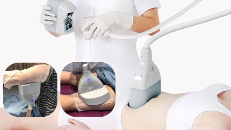 cryolipolysis 360