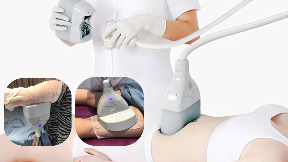 cryolipolysis 360