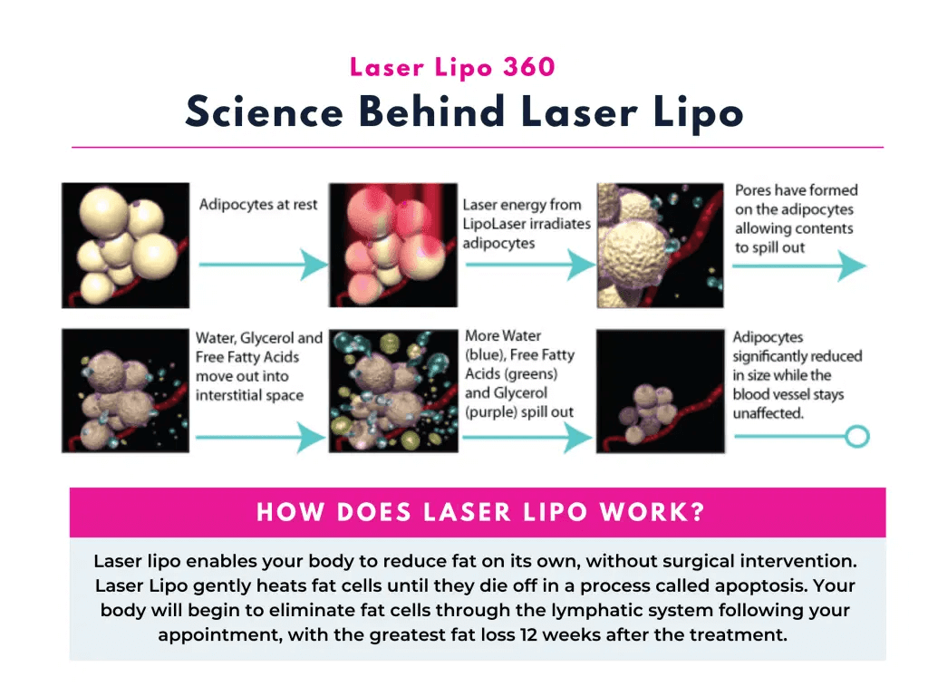 how does a laser lipo machine work