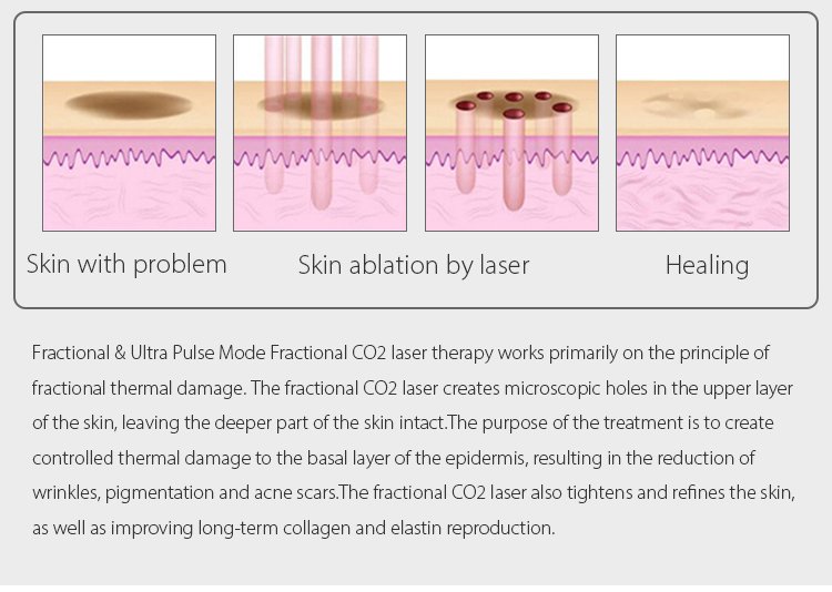 Fotona 4d Pro Laser Machine